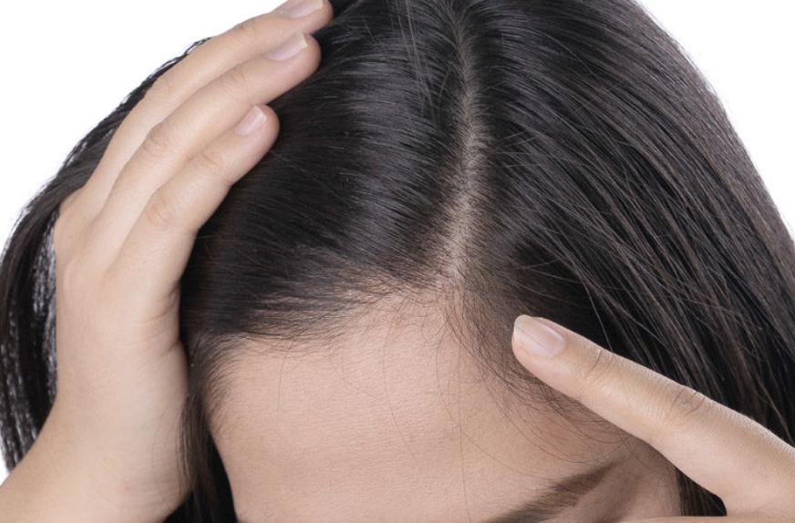 Primer plano de una persona apartando su cabello oscuro con las manos para mostrar el cuero cabelludo y el nacimiento del pelo.