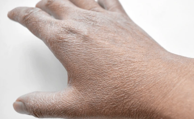 Primer plano detallado de la piel del dorso de una mano con signos severos de sequedad, descamación y falta de hidratación sobre un fondo blanco.